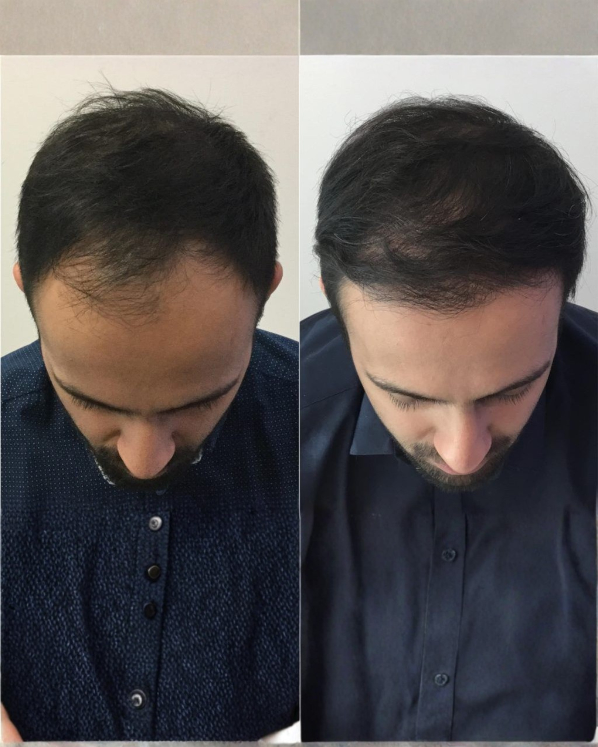 Before and after result